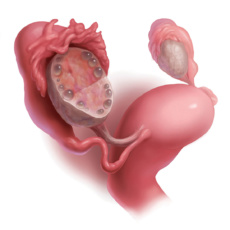 СПКЯ (синдром поликистозных яичников) и репродуктивная функция. Возможности КИО (контролируемая индукция овуляции) и ЭКО у женщин с СПКЯ