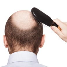 Можно ли “вернуть волосы” лишь коррекцией внутренних нарушений? Зачем нужен трихолог.