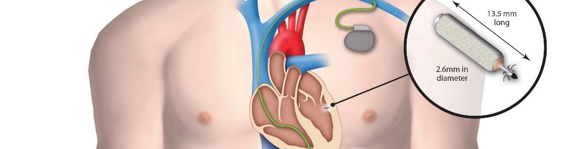 Беспроводной кардиостимулятор: новые доказательства эффективности и безопасности