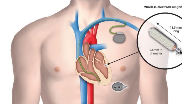 Беспроводной кардиостимулятор: новые доказательства эффективности и безопасности