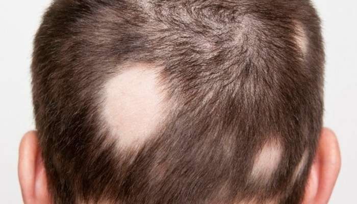 Все о выпадении волос. Часть 3. Гнездная алопеция