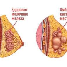 Мастопатия: гинекология, эндокринология или эндокринная гинекология?